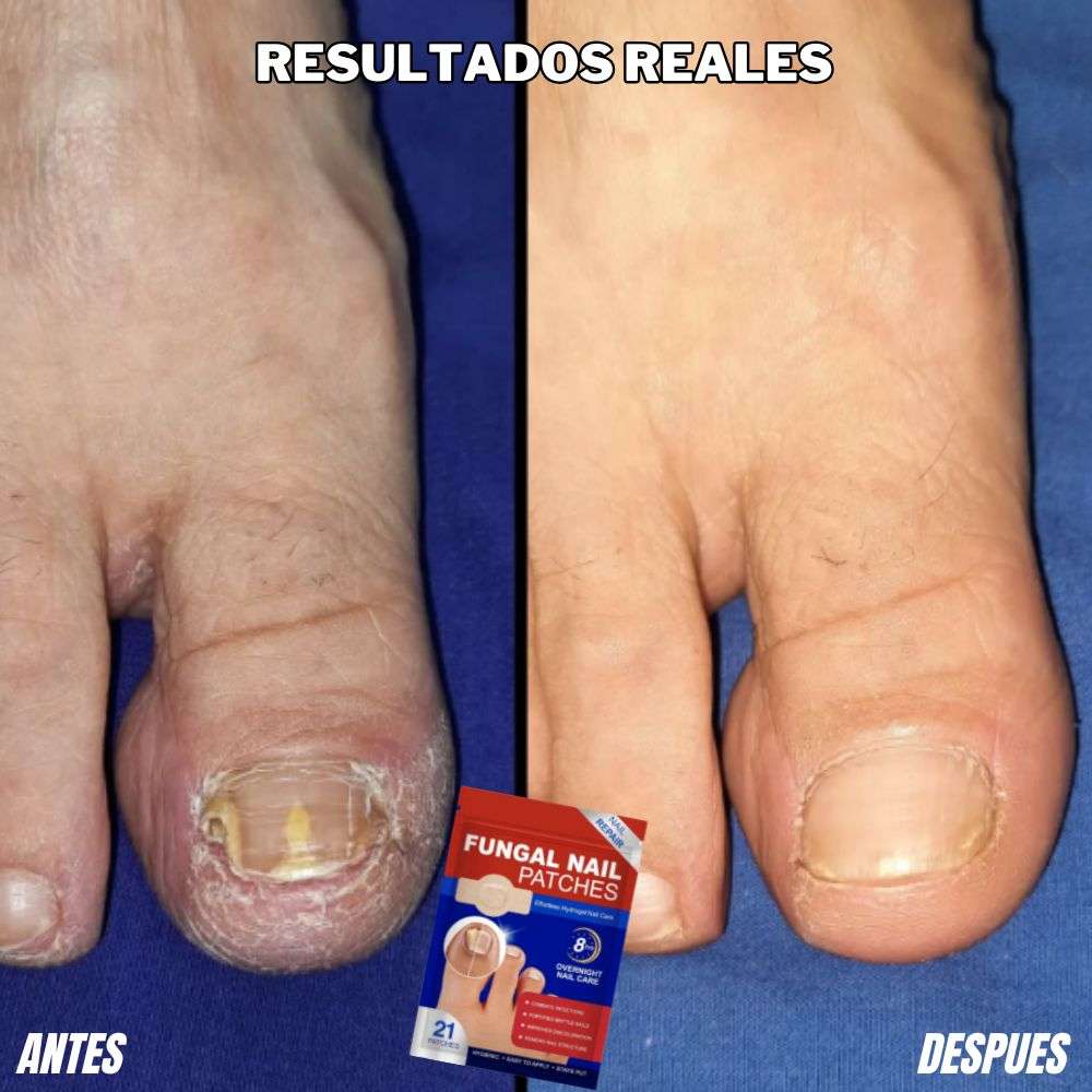 Parches termoregenerativos de uñas eliminadores de Hongos