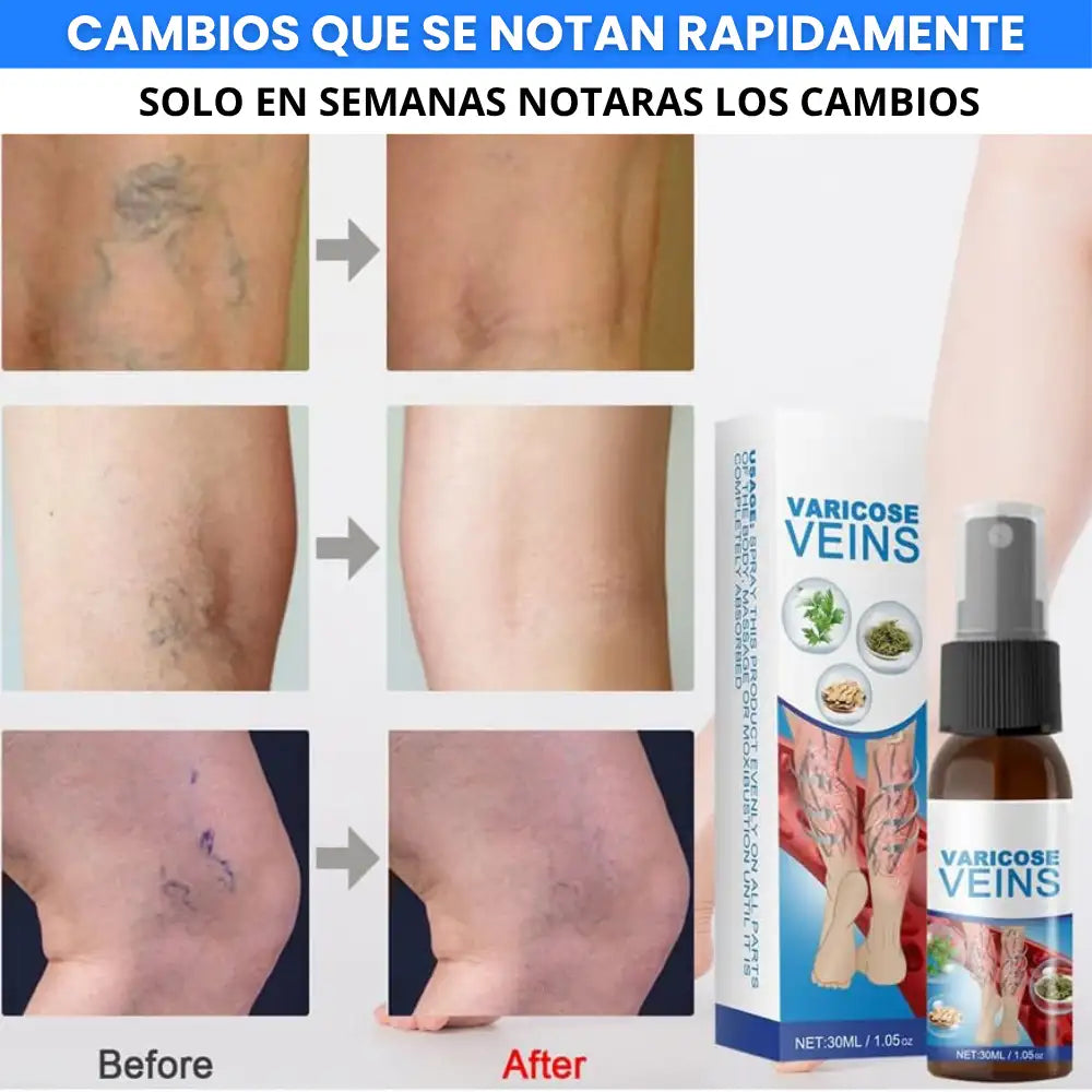 Spray Varicoce Veins® : Piernas mas sanas, Pasos mas firmes 🦵Paga 1 y Lleva 2 ¡Super Oferta SOLO POR HOY 🚀 40% de Descuento!