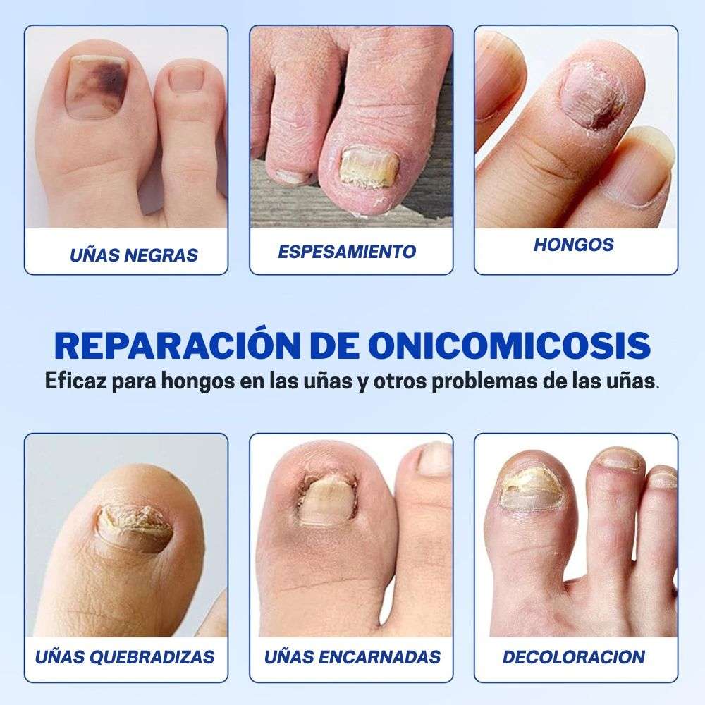 Parches termoregenerativos de uñas eliminadores de Hongos