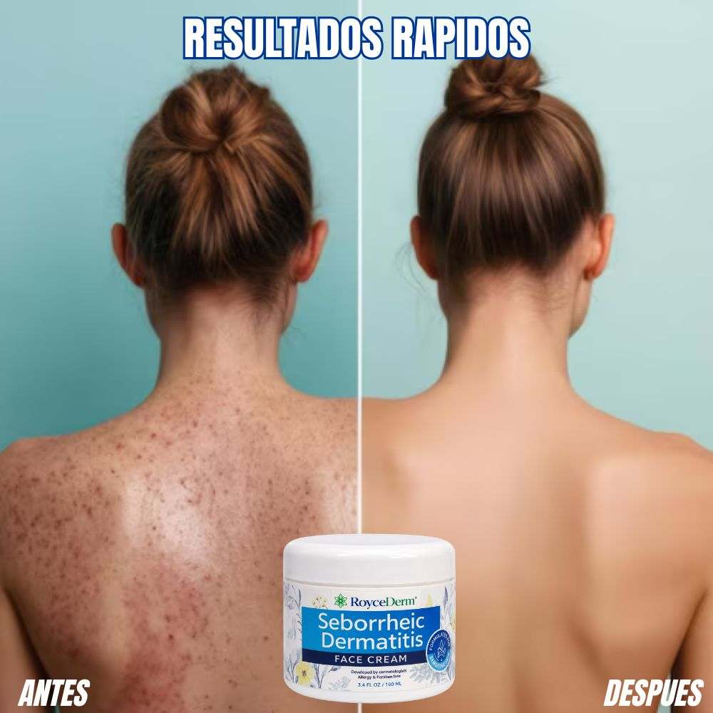 Royce Derm® Crema Para la Dermatitis y Psoriasis solo por hoy 30% de Descuento 🚀