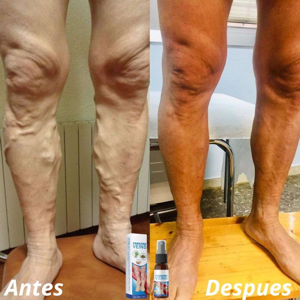 Spray Varicoce Veins® : Piernas mas sanas, Pasos mas firmes 🦵Paga 1 y Lleva 2 ¡Super Oferta SOLO POR HOY 🚀 40% de Descuento!