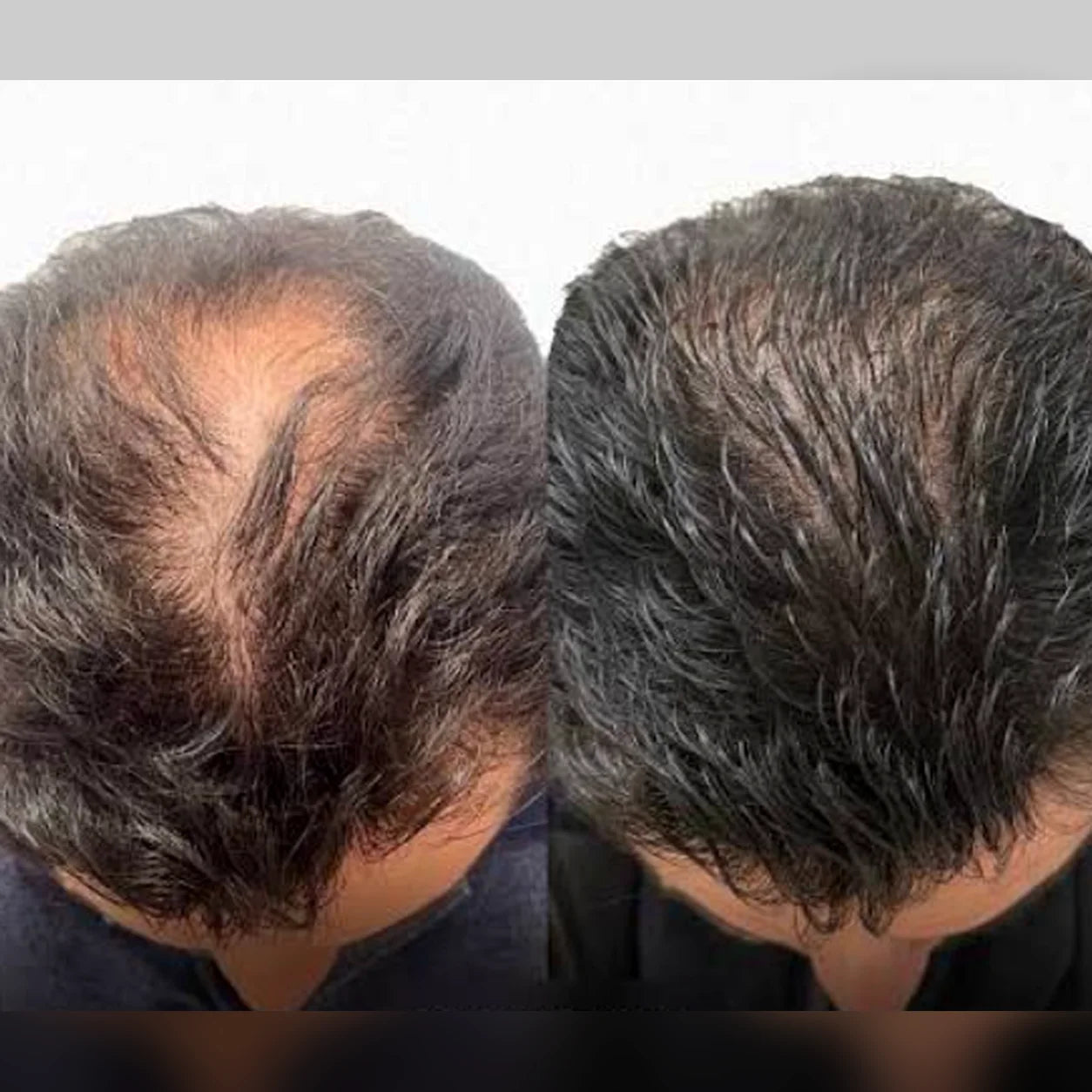 Comparativa proporcionada de un hombre: menor densidad capilar a la izquierda y mayor cobertura visual a la derecha.