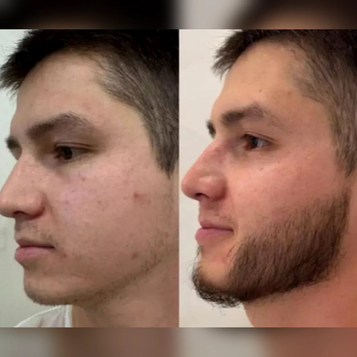 Comparativa proporcionada del mismo hombre sin barba a la izquierda y con barba a la derecha.